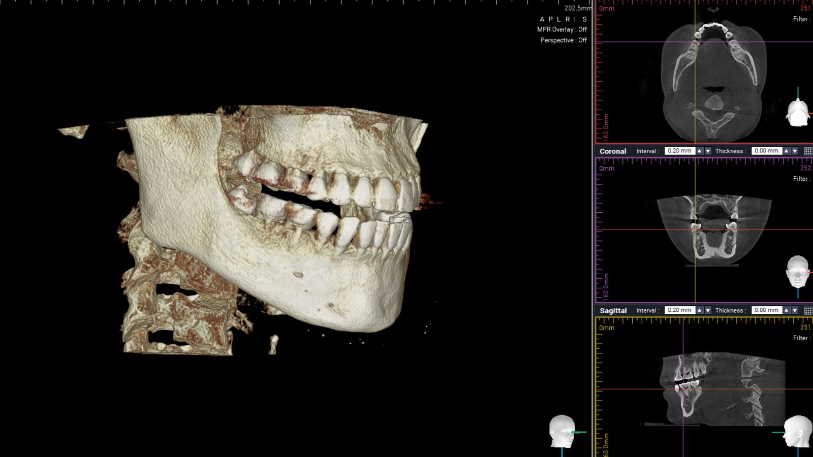 CT 3D 영상과 세 방향 단면 · 원내 자료